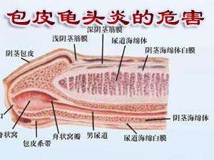 【必知】包皮龟头炎的危害有什么？